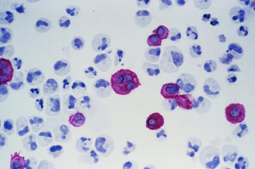 Fig. 3. Ex vivo expanded cells. / Cells were stained with CD41b and APAAP to identify mature megakaryocytes. A typical expanded product is shown.