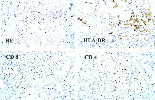 Fig. 2. Histologic analysis of a soft-tissue nodule from patient no. 8. / This lesion was analyzed for infiltrating lymphocytes using monoclonal antibodies against CD4, CD8, and HLA-DR. In addition, conventional hematoxylin-eosin staining was performed.