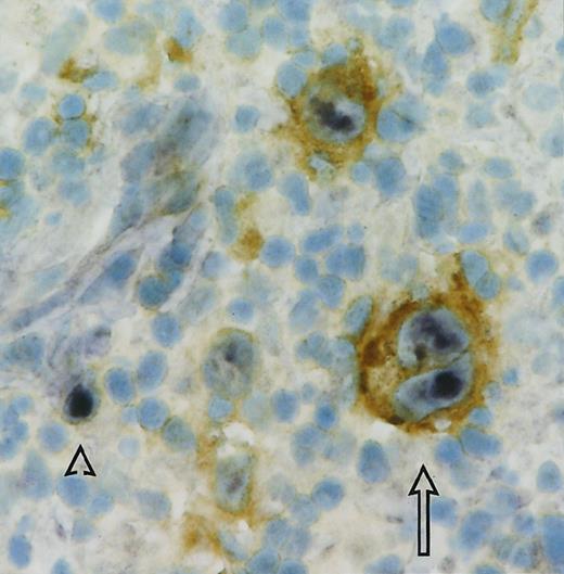 Fig. 1. Double staining for CD30 and EBER of case 1. / Immunhistochemical detection of CD30 shows brown membrane staining of multinucleated HRS cells (one marked with an arrow, ABC technique with HRP and DAB as substrate). EBER-ISH positive HRS cells and one small CD30-negative cell (marked by an arrowhead) show blue-black nuclear staining (digoxigenin-labeled EBER probes were detected with AP and BCIP/NBT as substrate). Original magnification, 40×.