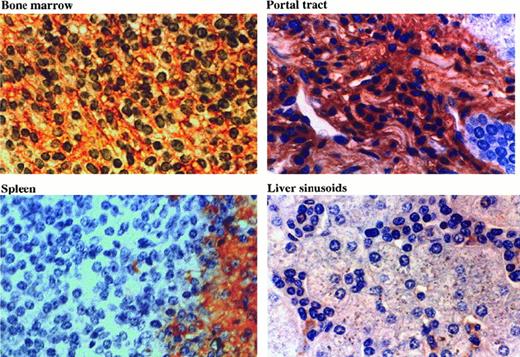 Fig. 5. Distribution of HA in HCL tissues. / Tissue sections were stained with HRP-conjugated HA binding protein (see “Materials and methods”). In bone marrow, a reticular network of HA is clearly seen. In portal tracts, the HA is associated with the dense matrix. Splenic red pulp lacks HA, whereas the residual white pulp is positive. In the hepatic sinuses, only the macrophages are stained.