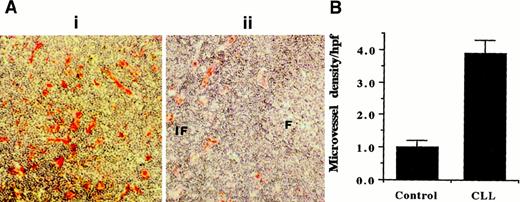 Fig. 1. Vessel density analysis using CD34 mAb staining. / (Ai) Representative CD34 staining of CLL node. (Aii) CD34 staining of normal node where interfollicular (IF) areas are vascularized, and follicular (F) areas display very little vascularization. Original magnification, × 10. (B) Quantitative analysis shows the higher vessel density in CLL nodes (n = 3) compared with follicular B-cell areas of normal nodes (n = 3).