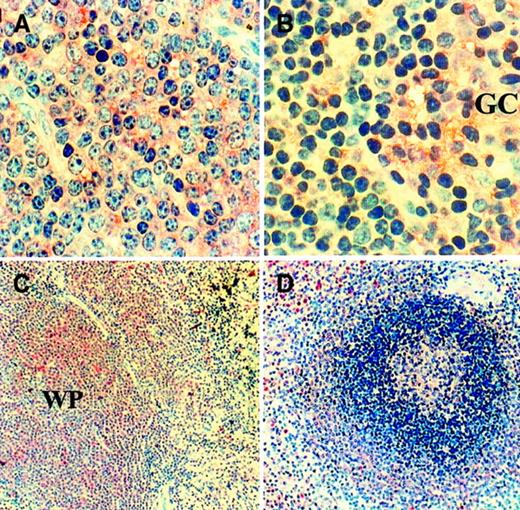 Fig. 3. Immunohistochemical staining of VEGF protein. / The presence of VEGF protein in CLL nodes (n = 3; CLL17 shown) and spleen (n = 2; CLL20 shown), together with corresponding normal tissues (n = 3), was examined using anti-VEGF antibody staining. Infiltrating cells in CLL lymph node (A) are all positive. Many cells in normal node (B) are also positive, particularly those in the germinal center (GC) of the follicles. (Original magnification, × 40.) CLL cells expanding the white pulp (WP) of the spleen (C) are also uniformly positive. In contrast, in normal spleen (D), the different layers of the white pulp show various degrees of positivity that was stronger in the marginal zone and follicle centers. (Original magnification, × 10.)