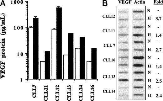 Fig. 7. VEGF production by CLL cells in response to hypoxic stimulation. / (A) CLL cells from 6 patients were cultured under normoxic and hypoxic conditions. After 24 hours, CM was collected and subjected to ELISA. Higher levels of VEGF protein were detected in the cells cultured under hypoxic conditions (▪) than in those grown under normoxic conditions (■). Histograms represent the mean of duplicates. Error bars are standard deviations calculated from 6 measurements in 3 separate experiments using the cells of 2 patients. (B) Cells from the same patients used for ELISA were also subjected to cellular VEGF mRNA determination by slot-blot hybridization. Hypoxia (H) compared with normoxia (N) increased VEGF mRNA expression in all cases. The bands were measured densitometrically, and the sample loading was determined by parallel measurement of the actin mRNA in each sample.