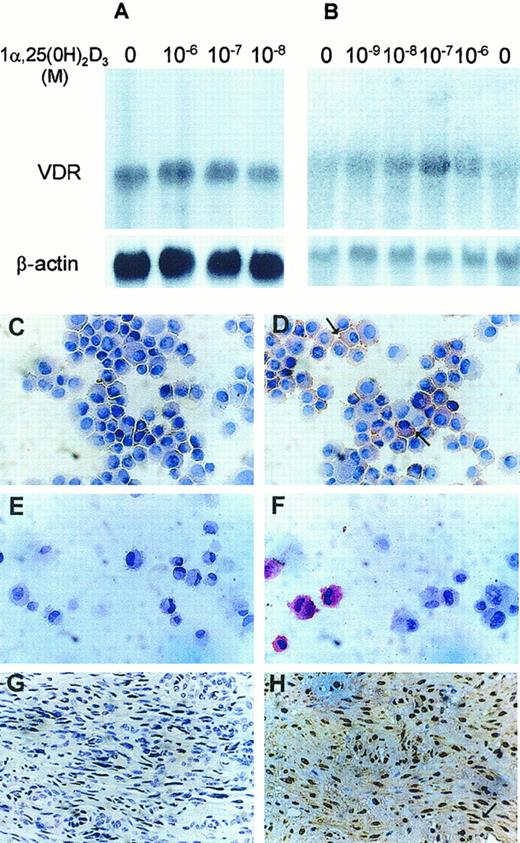 Fig. 1. Expression of vitamin D3 receptor in KS Y-1, HUVEC, and KS tumor tissue. / VDR mRNA in KS Y-1 (A) and in HUVECs (B). Cells were treated with various concentrations of vitamin D3 for 24 hours, and total RNA was extracted. Total RNA (15 μg) was electrophoresed, blotted, and hybridized to32P-labeled full-length human VDR cDNA (upper panels) and β-actin (lower panels), and exposed to x-ray film until signal was detectable (16 hours for VDR and β-actin in panel A, 3 days for VDR in panel B, and 4 hours for β-actin in panel B). Both cell types express the 4.6 kb mRNA for VDR. Immunocytochemical analysis for VDR expression. KS cell line (KS Y-1) and HUVECs were stained for VDR by using monoclonal antibody. KS cells (D) and HUVECs (F) show positive signal, whereas cells stained with isotype-specific antibodies were negative (C and E, KS and HUVEC, respectively). Antibody was used at 1:50 dilution for the KS Y-1 cells and 1:25 for the HUVECs. KS tumor tissue showed strong VDR-specific signal in spindle cells (H), whereas no staining was observed in KS tumor tissue stained with isotype-specific control (G).