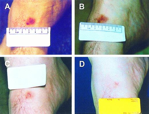 Fig. 8. Effect of calcipotriene on a KS lesion of an HIV-negative patient. / Calcipotriene ointment (0.005%) was applied twice daily to the lesion. (A) The tumor before initiation of treatment. (B) After 2 months. (C) After 18 months. (D) After 39 months. Tumor response is apparent at 2 months, with marked reduction after 18 months and complete resolution by 39 months.