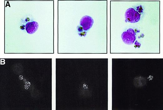 Fig. 1. Nonopsonic phagocytosis of. / P falciparum PEs. Synchronized, nonopsonizedP falciparum trophozoite PE cultures were incubated with adherent, Fc receptor–blocked human monocytes in 10% heat-inactivated fetal calf serum for 4 hours as described in “Materials and methods.” Nonadherent erythrocytes were washed away and adherent erythrocytes removed by hypotonic lysis. After washing, monocytes were fixed and prepared for light microscopic examination (A) or for IC4 monoclonal antibody immunofluoresence (B). (A) Three panels of representative monocytes are shown under light microscopy. Each panel contains 1 or 2 monocytes, with several ingested PEs. (B) Three panels of representative monocytes analyzed by IC4 monoclonal antibody immunofluorescence following PE phagocytosis. The typical speckled pattern produced by IC4 binding to the PE surface can be readily appreciated in the ingested PEs. All results shown are indicative of results obtained on at least 3 independent occasions. Original magnification, × 1000.