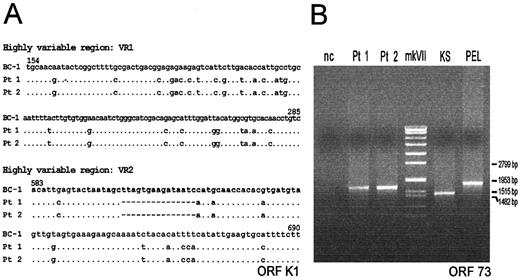 Fig. 1. Alignment of the nucleotide sequences and genotyping of the internal repeat domain detected in the KS lesions. / (A) Alignment of the nucleotide sequences of the 2 highly variable regions (VR1 and VR2) of the orf-K1 gene. The alignment includes a prototype K1 sequence (clade A) from the BC-1 PEL cell line (GeneBank accession number U75698), and the K1 sequences (clade C) detected in the KS lesions from each of the 2 renal recipients (Pt 1 and Pt 2), after transplantation. Dots indicate identity with the first sequence in the alignment. (B) Genotyping of the polymorphic internal repeat domain of orf-73 gene detected in the KS lesions from each of the 2 renal recipients (Pt 1 and Pt 2), after transplantation, in the cutaneous KS lesion from an elderly Italian patient with classic KS (KS), and in the pleural PEL specimen from an elderly HIV negative Italian patient (PEL). nc, negative control, represented by the DNA from HHV-8 negative Raji cell line; mk VII, molecular weight marker (Boehringer Mannheim, Germany).