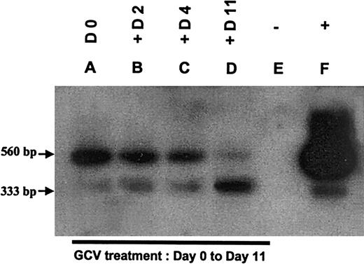 Fig. 7. Southern blot analysis of TK PCR products of peripheral blood mononuclear cells from a representative patient of the clinical trial at time of GVHD (day 30 after allograft) during GCV treatment. / Lanes A-D: DNA samples extracted from peripheral blood mononuclear cells of the patient at time of GVHD (A), 2 days (B), 4 days (C), 11 days (D) after the beginning of the GCV treatment. Lane E: negative control (nontransduced primary T cells). Lane F: positive control (DNA from G1Tk1SvNa vector producer cells).