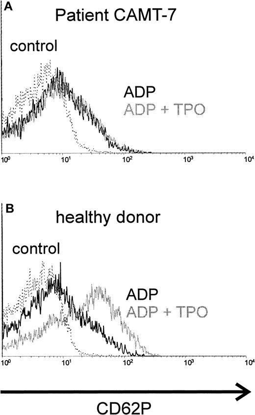 Fig. 1. Costimulation of platelets with rhTPO, CAMT versus healthy control. / Platelets of patient CAMT-7 (A) and of a healthy control donor (B) were stimulated with ADP (5 μM) after preincubation with or without rhTPO (50 ng/mL). Flow cytometric analysis of platelet activation was performed using a monoclonal antibody against CD62P. CD62P expression of unstimulated platelets is shown in each histogram.