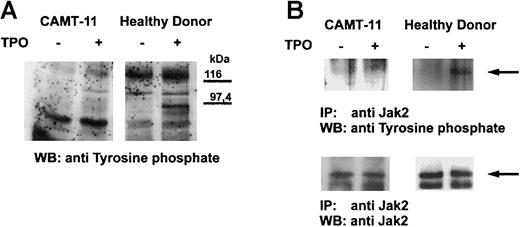 Fig. 2. Tyrosine phosphorylation in platelets after TPO stimulation. / Platelets of patient CAMT-11 and of a healthy donor were preincubated with 2.7 μg/mL rhTPO before lysis and Western blot analysis of tyrosine-phosphorylated proteins (A). Phosphorylation of Jak2 was proved after immunoprecipitation with anti-Jak2 and Western blot detection of tyrosine-phosphorylated proteins and Jak2 (B).