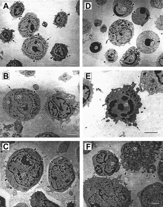 Fig. 2. Micrographs of bone marrow–derived CD15+, CD33+, and CD34+ cells. / Panels A-C show cells from a healthy volunteer, and panels D-F show cells from a patient with CN. (A) Control CD15 cells. The cell surface forms few short irregular microvilli (arrows). The nucleus (N) is multilobed with irregular patches of granular heterochromatin. Electron-dense granules, mitochondria, and endoplasmic reticulum are distributed throughout the cytoplasm (arrowheads). Scale bar = 2 μm. (B) Control CD33+ cells. The cell on the right has numerous microvilli on the surface (arrows). The polymorphous nucleus (N) contains patchy granular heterochromatin. Mitochondria (arrowheads) and a Golgi complex (*) can be observed in the cytoplasm. Scale bar = 2 μm. (C) Control CD34+ cells. The cell surface forms few microvilli (*). The cells contain an irregular shaped nucleus (N) with patchy granular heterochromatin, numerous mitochondria (arrows), endoplasmic reticulum (arrowheads), and Golgi fields (*). Scale bar = 2 μm. (D) Several apoptotic cells are shown surrounding a normal cell (*). The apoptotic cells are rounded and show no microvilli on the surface. Rounded nuclei (N) contain condensed heterochromatin in distinctly circumscribed, granular masses (arrows) along the inner surface of the nuclear envelope. The cytoplasm shows few, sometimes swollen cell organelles (arrowheads) and few or no electron-dense granules. Scale bar = 2 μm. (E) CD33 cells from CN patient with irregular shape and extensive membrane blebbing on the cell surface (arrows). The nucleus (N) contains distinct patches of heterochromatin. Mitochondria and a slightly swollen endoplasmic reticulum are distributed in the cytoplasm. Scale bar = 2 μm. (F) CD34 cells from CN patients demonstrate nuclear fragmentation (arrows) and severe plasma membrane blebbing and cellular fragmentation (arrowheads). N indicates nucleus. Scale bar = 2 μm.