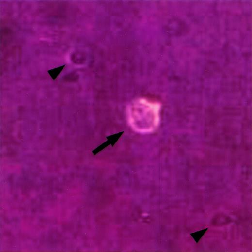 Fig. 1. Identification of single HRS cells in cell suspension. / A single cell suspension was prepared from a lymph node involved by HL, stained with an anti-CD30 antibody coupled to phycoerythrin, and viewed under an inverted fluorescence microscope as previously described.23 A single HRS cell is identified by its large size, bilobed nucleus with prominent nucleoli, and CD30 expression (arrow). Note smaller CD30-negative cells in the background (arrowheads).
