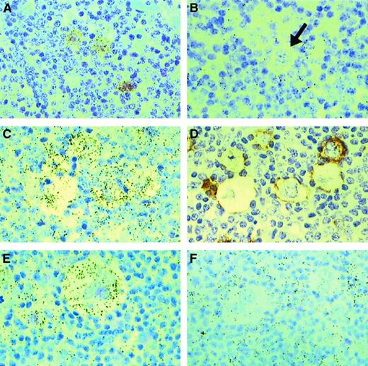 Fig. 2. IL-13 and IL-13Rα1 expression in Hodgkin lymphoma. / In situ hybridization for IL-13 (A, B) and IL-13Rα1 (C, E, F); black-colored silver grains denote mRNA expression. HRS cells from a case of mixed cellularity HL (A) express IL-13, whereas an L&H cell (arrow) from a case of NLPHL (B) is negative for IL-13. HRS cells from 2 cases of nodular sclerosis HL (C, E) express IL-13Rα1, whereas HRS cells from a case of mixed cellularity HL (F) are negative for IL-13Rα1. Serial sections from one of the cases of nodular sclerosis (C, D) were hybridized with an IL-13Rα1 antisense probe (C) or stained for CD30 (D), illustrating IL-13Rα1 expression in CD30+ HRS cells. Note IL-13Rα1 expression in surrounding lymphocytes and histiocytes (C, F).