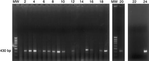 Fig. 4. IL-13Rα1 expression by individual HRS cells. / Single HRS cells from case 37 were micromanipulated and subjected to polyA PCR as described in “Materials and methods.” PolyA cDNA products from 20 individual HRS cells (lanes 1-20) were amplified by PCR with IL-13Rα1–specific oligonucleotides. The 430-bp PCR product indicates IL-13Rα1 gene expression in 15 of 20 single HRS cells. The presence of IL-13Rα1 cDNA was confirmed by hybridization with an internal oligonucleotide. MW = 100-bp ladder; lanes 1-20: single HRS cells; lane 21: negative control (single HRS cell, no reverse transcriptase); lane 22: blank; lane 23: negative control (H20); lane 24: positive control (cDNA from KM-H2 cells).