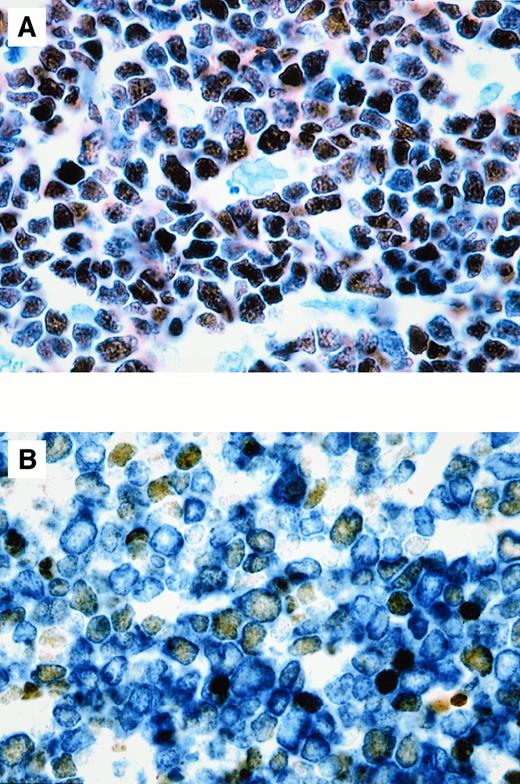 Fig. 1. BCL-6 expression in T-LBL. / The percentage of BCL-6+ cells in T-LBL ranged from 50% to more than 90%. (A) Case No. 1. More than 90% of tumor cells, corresponding phenotypically to a double-positive (CD4+, CD8+) common thymocyte, show nuclear expression of BCL-6. (B) Double-staining for BCL-6 and CD3 in case No. 4, corresponding phenotypically to a double-negative (CD4−, CD8−) precursor thymocyte, shows that approximately 50% of the CD3+ malignant lymphoblasts (cytoplasmic, blue) express BCL-6 (nuclear, brown). Original magnification × 1000 (A), × 1000 (B).