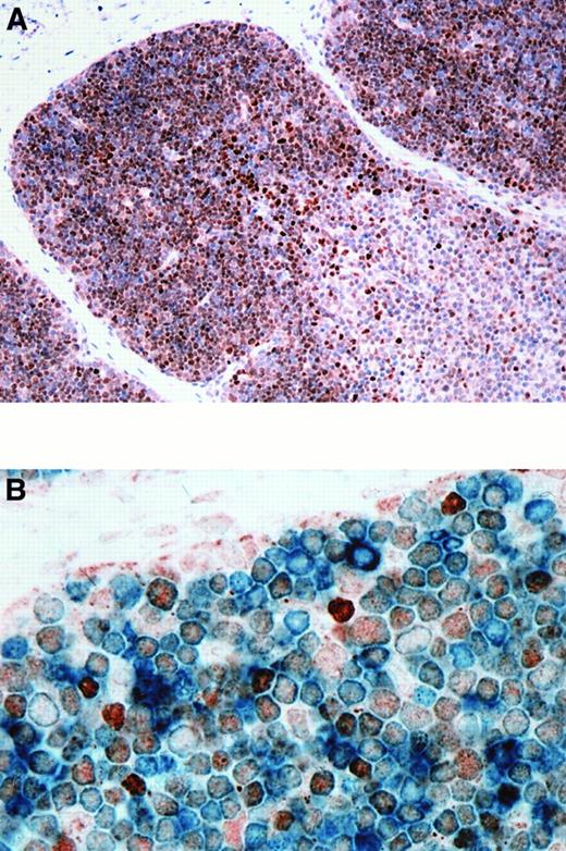 Fig. 2. BCL-6 expression in normal thymus. / (A) BCL-6 was expressed by 60% to 90% of thymocytes in the cortex. Less than 20% of the cells in the medulla were BCL-6+. (B) Double staining for BCL-6 and CD3 in thymus shows that most CD3+ cortical thymocytes (cytoplasmic, blue) express BCL-6 (nuclear, brown). BCL-6+ thymocytes also express CD1a, CD2, CD4, CD5, CD7, and CD8 (21 weeks gestational age). Original magnification × 200 (A), × 1000 (B).