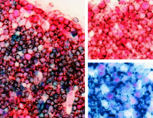 Fig. 3. BCL-6 expression in double-positive (CD4+, CD8+) cortical fetal thymocytes. / Three-color staining for BCL-6 (nuclear, pink-red), CD4 (cytoplasmic, brown), and CD8 (cytoplasmic, blue) of cortical thymocytes. Most cortical thymocytes expressing BCL-6 (nuclear, pink-red) are CD4+, CD8+ double-positive thymocytes (cytoplasm, muddy brown-blue). Insert, upper right corner, shows double staining for BCL-6 (nuclear, pink-red) and CD4 (cytoplasmic, brown) of cortical thymocytes; insert, lower right corner, shows double staining for BCL-6 (nuclear, pink-red) and CD8 (cytoplasmic, blue) (21 weeks gestational age). Original magnification × 1000.