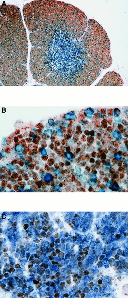 Fig. 4. BCL-6 and BCL-2 expression in normal fetal thymus and T-LBL. / (A) Double staining for BCL-6 and BCL-2 in thymus. BCL-6+cells (nuclear, brown) were primarily present in the cortex, while BCL-2+ cells (cytoplasmic, blue) were primarily seen in the medulla. (B) Higher magnification showing that most cortical thymocytes expressing BCL-6 are BCL-2−. Only scattered cortical thymocytes are BCL-2+ and do not express BCL-6 (21 weeks gestational age). (C) Double staining for BCL-6 and BCL-2 in T-LBL (case No. 2) showing that neoplastic T lymphoblasts coexpress BCL-6 (nuclear, brown) and BCL-2 (cytoplasmic, blue). Original magnification × 100 (A), × 1000 (B), × 1000 (C).