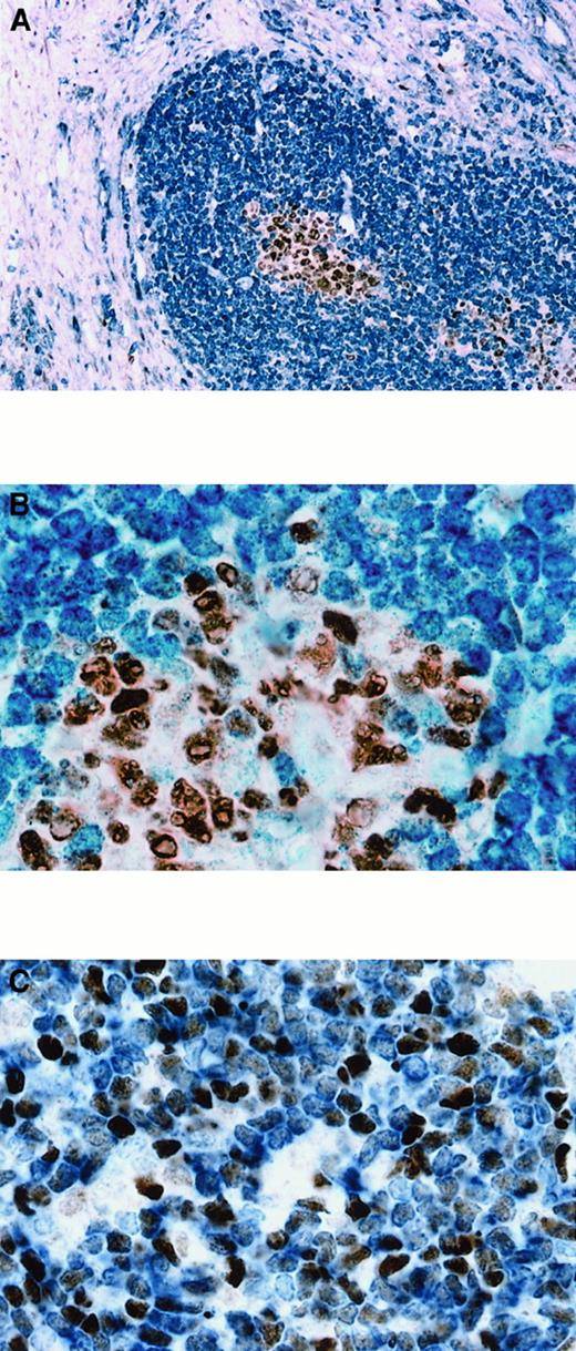 Fig. 5. BCL-6 and BCL-2 expression in reactive lymph node and follicular lymphoma. / (A) Double staining for BCL-6 and BCL-2 in reactive lymph node showing analogy between BCL-6 and BCL-2 expression in thymic cortex (Figure4A,B) and germinal centers of lymphoid follicles. BCL-6+cells (nuclear, brown) are present in germinal centers, while BCL-2+ cells (cytoplasmic, blue) are seen primarily outside germinal centers. (B) Higher magnification shows that most germinal center cells express BCL-6 and are BCL-2−. Only scattered cells in germinal centers are BCL-2+ and do not express BCL-6. (C) Double staining for BCL-6 and BCL-2 in a case of follicular lymphoma showing analogy between the pattern of BCL-6 (nuclear, brown) and BCL-2 (cytoplasmic, blue) coexpression between follicular lymphoma and T-LBL (Figure 4C). Original magnification × 100 (A), × 1000 (B), × 1000 (C).