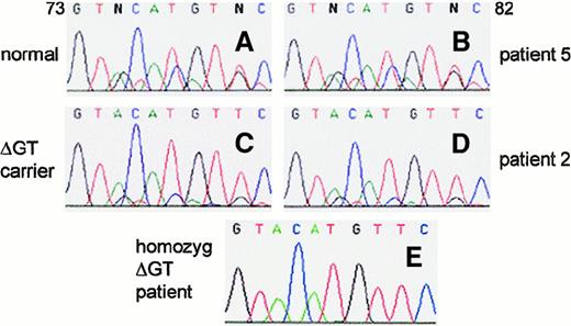 Fig. 2. Identification of A470 CGD patients who were not homozygous for the common ΔGT mutation. / Genomic DNA from a nonaffected donor, a classic (ΔGT/ΔGT) A470 CGD patient and carrier parent, and patients 2 and 5 was amplified using primers 2LB2 and 2RB2, which do not differentiate between NCF-1 and ψNCF-1. Electropherograms show the first 10 nucleotides of exon 2. In the nonaffected person (A), co-amplification of functional gene and pseudogene DNA was evident because the sequences diverged after the initial GT. In contrast, the ΔGT/ΔGT A470 CGD patient showed only pseudogene sequence (E). The obligate heterozygous carrier of this common form of the disease exhibited both NCF-1 and ψNCF-1sequence (C) but with a much higher pseudogene–functional gene ratio than seen in normal DNA. Patients 1 to 4 (only patient 2 is shown; D) had electropherograms similar to those of the carrier, indicating they were heterozygous for the ΔGT mutation. Patients 5 and 6 (only patient 5 is shown; B) were similar to the normal control, suggesting their p47-phox deficiency was not associated with a GT deletion in NCF-1.