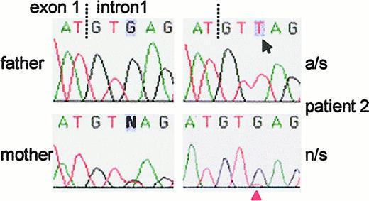 Fig. 3. Sequence analysis of the exon 1/intron 1 junction in the GTGT-containing allele of. / NCF-1 in patient 2. The patient's G → T mutation at the +3 position of the 5′ (donor) splice site of intron 1 is easily observed after allele-specific (a/s) PCR to amplify only the GTGT-containing allele (arrow, upper right panel). The patient's father, who carried the ΔGT mutation on the other allele (not shown), had the normal G at this position. The patient's mother was heterozygous for the G → T mutation. In the patient's non-allele–specific (n/s) PCR product, the mutant T was barely detectable above background (red arrowhead, bottom right panel) and was dominated by the normal G arising in the ΔGT allele ofNCF-1 and in ψNCF-1 DNA.