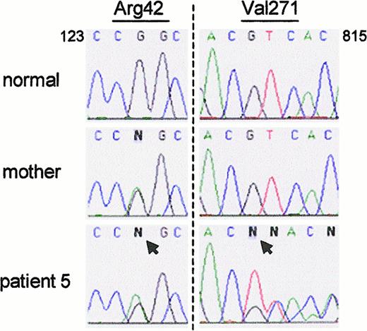 Fig. 5. Patient 5 was a compound heterozygote for 2 non-ΔGT mutations. / (left panel) The patient and his mother were both heterozygous for a G125 → A transition in exon 2 (arrow) that predicts the amino acid change Arg42 → Gln. (right panel) The patient was also heterozygous for the deletion of G811 (arrow); sequence from normal and mutant alleles can be seen after nucleotide C810. The patient's mother was normal at this position.