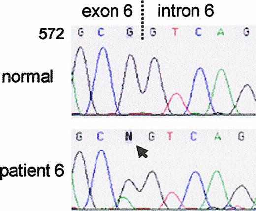 Fig. 6. Sequence analysis of the NCF-1 exon 6/intron 6 junction in genomic DNA of patient 6. / Non-allele–specific amplification and sequencing of genomic DNA from patient 6 revealed a single nucleotide change from the normal sequence, a G574 → A transition (arrow). The mutation is likely to disrupt splicing because it alters the final nucleotide of exon 6, but it also predicts a change of Gly192 → Ser.