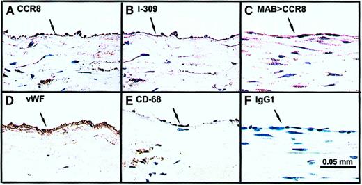 Fig. 7. CCR8 is found on the endothelium in human coronary endarterectomy specimens. / Sections of human coronary endarterectomy specimens were stained with polyclonal antibody for CCR8 (A), I-309 (B), murine monoclonal antibody against CCR8 (C), vWF antigen (D), monocyte/macrophage antigen CD-68 (E), and the IgG1 isotype control for the monoclonal antibody against CCR8 (F). Endothelial cells in the lesion, identified by their staining for vWF antigen (D, arrow) stain positively for CCR8 with both polyclonal and monoclonal antibodies (A,C, arrows), and for I-309 (B, arrow). Anti-CD-68 did not stain the endothelium (E, arrow); however, it stained cells in the subendothelial neointima. The murine IgG1 isotype control did not stain the endothelial surface (F, arrow) or the underlying tissue. (DAB-peroxidase, hematoxylin counterstain, original magnification × 400).