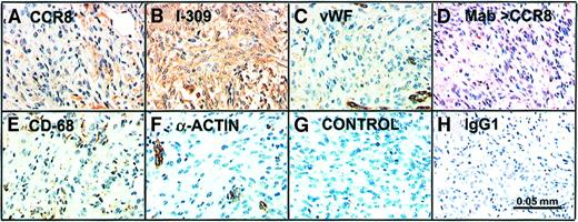 Fig. 8. Kaposi sarcoma shows diffuse staining for CCR8 and I-309. / Biopsies of Kaposi sarcoma were stained for multiple antigens as detailed in “Materials and methods.” Shown is a Kaposi sarcoma patch stained with goat polyclonal anti-CCR8 (A), anti-I-309 (B), anti-vWF (C), murine monoclonal anti-CCR8 (Mab > CCR8; D), anti-CD-68 (E), anti-α-actin (F), secondary antibody alone (Control, G), and isotype control IgG1 (H). The Kaposi sarcoma spindle cells stain intensely for CCR8 with both the polyclonal and monoclonal antibodies (A,D). The spindle cells also stain diffusely for vWF and CD-68 (C,E). Pericytes in small vessels stain for α-actin (F). There is no staining when the primary antibody is omitted (G), and only a trace staining with the mouse IgG1 isotype control (H). (DAB-peroxidase, hematoxylin counterstain, original magnification × 200).