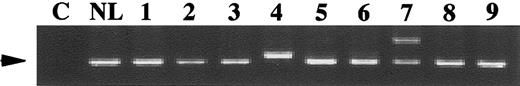 Fig. 1. Genomic PCR for the Flt3/ITD. / Genomic DNA prepared from diagnostic marrow specimens were PCR amplified and resolved on polyacrylamide gel. C, non-nucleic acid control; NL, normal marrow control; 1-9, samples from 9 different pediatric patients. High-molecular weight bands in lanes 4 and 7 represent the Flt3/ITD. Patient sample in lane 4 does not have a normal Flt3 band. This patient was previously shown to have a loss of heterozygosity (LOH) of chromosome 13 at the region of theFlt3 gene. Arrow points to the normal Flt3 gene product.