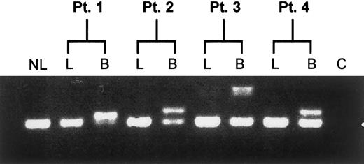 Fig. 2. Lineage restriction analysis of the Flt3/ITD. / Diagnostic bone marrow specimens from Flt3/ITD-AML patients were flow sorted for lymphocyte and blast fractions and assayed for the presence of the Flt3/ITD. Result of the assay from 4 representative patients is shown. NL, normal bone marrow control; C, non-nucleic acid control; L, lymphocyte fraction; B, myeloblast fraction.