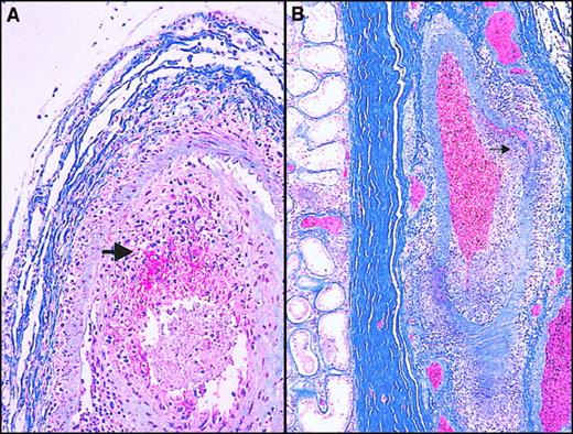 Fig. 1. Histopathologic findings obtained at postmortem. / (A) Choroidal vessel stained with Martius-scarlet-blue (MSB) shows necrotizing vasculitis with a mononuclear cellular infiltrate and fibrin deposition (red). (B) Hilar testicular vessel stained with MSB shows necrotizing arteritis, segmental/asymmetric accumulation of mononuclear cells in the vessel wall (large arrowhead). Note the focal nodose dilatation characteristic of polyarteritis nodosa (small arrowhead).