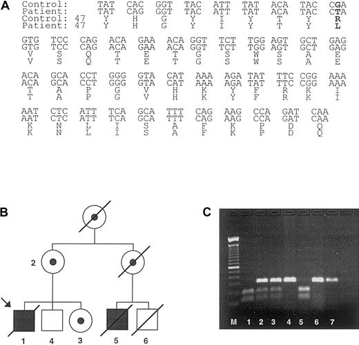 Fig. 2. SAP mutation and identification of patients. / (A) The gene mutation present in the index case consisted of a G to T mutation in exon 2 of SAP that leads to an arginine to leucine transposition at Arg55 (bold letters). (B) A pedigree was constructed based on the index case. The symbols used are proband (arrow), males (box), females (circle), deceased (line through), affected male (black fill), female carriers (dotted fill), and unaffected subjects (no fill). The SAP mutation introduces a restriction endonuclease recognition site into exon 2 of the SAP gene. DNA isolated from (1) index case and (5) affected male cousin; (2) mothers of index case; (3) sister of index case; (4) brother of index case; (6) unaffected male cousin and (7) unrelated healthy control were subjected to PCR amplification with primers specific for SAPexon 2, and the amplified product was digested with BfaI and visualized on an agarose gel (C). The numbers on the pedigree match the numbers on the agarose gel. Affected male patients are identified by 2 bands of the digested products, whereas carriers have a mixture of the undigested and digested exon 2. The unaffected relative (6) died of a condition unrelated to XLP.