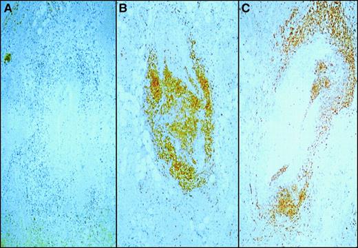 Fig. 3. Immunophenotype of vessel wall infiltrate. / Sections of testes containing vessels infiltrated with mononuclear cells were stained with monoclonal antibodies to CD20 (panel A), a B-cell marker; CD45R0 (panel B), a pan T-cell marker and CD8 (panel C), a cytotoxic T lymphocyte marker. The primary antibodies were then labeled with horseradish peroxidase–conjugated antibody and reacted with color substrate. Note the absence of CD20 (panel A) staining and the large proportion of mononuclear cells staining brown indicating the presence of CD45R0 and CD8 cells.