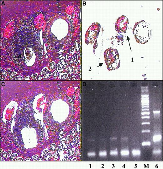 Fig. 4. PCR amplification of vessel wall tissue. / Sections containing affected testicular arteries were microdissected to remove vessel wall cells. H&E stain of section before dissection (A) and after dissection (C) show that portions of the vessel were removed. DNA was prepared from the removed sections labeled 1 and 2 (B) and subjected to EBV-specific amplification by PCR (D). The amplified products were visualized by gel electrophoresis and ethidium bromide staining. Lanes 1 and 2, vessel wall dissections as labeled in panel B; lane 3, amplification of an EBV-positive lymphoblastoid cell line; lane 4, seminiferous tubule; lane 5, negative control; and lane 7, 1 ng EBV-positive genome.