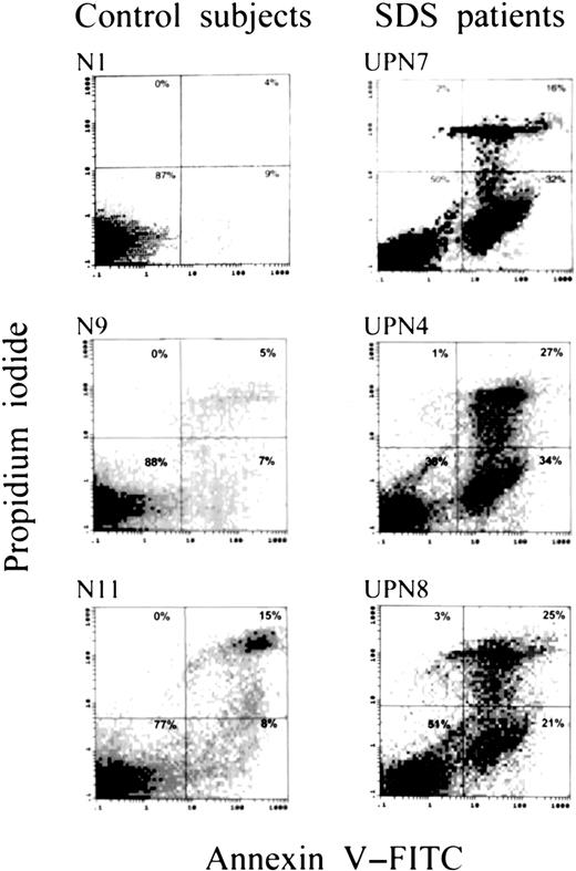Fig. 1. Apoptosis rate of cultured marrow mononuclear cells. / Representative dot plots of apoptosis analysis of marrow cells from 3 patients and 3 control subjects after 7 days of incubation, showing larger populations of apoptotic cells and smaller populations of viable cells in the patients.