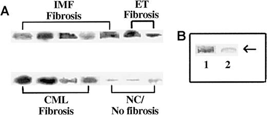 Fig. 2. Immunoprecipitation of SP-IR in the sera of subjects with and without BM fibrosis. / Sera (1 mL) were immunoprecipitated with anti-SP and then analyzed by Western blot for SP with the same antibody. (A) Representative samples are shown for patients with fibrosis: IMF, ET/IMF, and CML. Lanes are shown for results obtained for NC or sera with fewer than 5 pg/mL SP and no fibrosis. (B) Immunoprecipitates were analyzed with anti-SP pre-absorbed with SP. Lane 1, regular anti-SP; lane 2, pre-absorbed anti-SP.