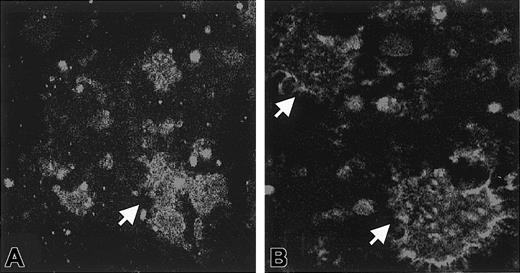 Fig. 2. Effect of saponin permeabilization on immunofluorescence. / Washed platelets were incubated with Stx1, and aggregates formed in the medium. In experiments in which immunofluorescence was performed in the presence of saponin, FITC staining was noted inside the aggregates for all concentrations of Stx1 (A, 1 ng/mL Stx1). In experiments in which immunofluorescence was assayed without saponin, FITC staining was noted on the periphery of aggregates. This was demonstrated for all concentrations of Stx1 (B, 1 ng/mL Stx1). Arrows indicate aggregates. Aggregates were identified as platelets by counterstaining with antibody to CD41-PE (not shown). Magnification, × 1000.