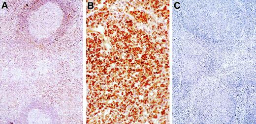 Fig. 7. Immunohistochemical detection of IL-10 protein in tissues. / Positive cells contain brown pigment (ABC immunoperoxidase, hematoxylin counterstsain). (A) Lymph node from a patient with ALPS shows staining for IL-10 concentrated in the paracortex. Cells in the germinal center are not stained (× 100). (B) At higher power, intense positivity for IL-10 is observed in most of the interfollicular lymphocytes (× 400). (C) No signal for IL-10 is observed in a reactive lymph node from a normal control (× 100).