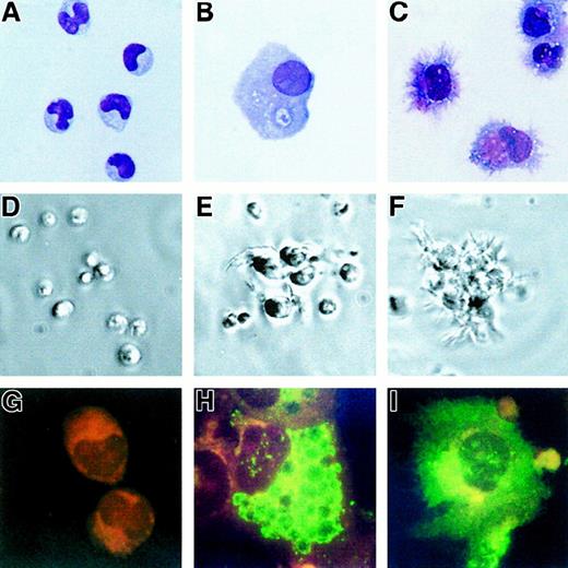 Fig. 3. IL-3 induces differentiation of leukemic cells. / The initial morphology of the tumor cells (patient GUE) (A) (× 63) stained with May-Grünwald Giemsa was highly modified after 6-day culture with IL-3: The cells enlarged (B) (× 63) and, when activated during the last 48 hours with CD40L-transfected L cells, they acquired many fine dendrites (C) (× 63). Tumor cells die in culture medium alone (D) (× 10, as shown in phase contrast microscopy). Some dendrites can be seen in culture with IL-3 alone (E) (× 10) and on most of the cells that are either isolated or within clusters after CD40L activation (F) (× 10). CD83 (green fluorescence, red counterstaining) was not detected in fresh cells (G) (× 100) but became apparent after culture with IL-3, being localized in the cytoplasm (H) (× 100) and expressed at the cell surface after CD40L activation (I) (× 100).