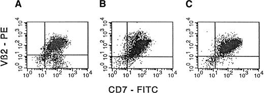 Fig. 3. Concordant expression of TCR Vβ2 by the primary T-ALL sample and engrafted NOD/SCID bone marrow and spleen. / MNCs from primary T-ALL obtained from a patient (A) and from bone marrow and spleen cells (B and C, respectively) harvested from a NOD/SCID mouse preconditioned with cord blood MNCs (10 × 106) and implanted with T-ALL leukemia from the patient (3.3 × 106 cells) were analyzed by flow cytometry for surface expression of TCR Vβ2. In the panels presented, the expression of Vβ2 was determined simultaneously with the expression of the T-ALL marker CD7. The CD7 and Vβ2 mAbs were used as FITC and PE conjugates, respectively. Isotype-matched control mAbs (FITC- or PE-conjugated IgG1) were used to determine appropriate cursor settings for analysis. Percentages of human Vβ2+CD7+ double-positive cells were 80%, 91%, and 93%, respectively, for samples A, B, and C.