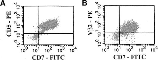 Fig. 5. Presence of leukemia cells in the peripheral blood of mice engrafted with primary T-ALL. / Mice were preconditioned with 10 × 106 cord blood MNCs before injection with 1.6 × 106 primary T-ALL cells. For the mouse presented here, the levels of T-ALL engraftment in bone marrow and spleen were 93% and 87%, respectively, followed both as CD5+CD7+ cells and Vβ2+CD7+ cells (not shown). Peripheral blood obtained from this mouse was analyzed by flow cytometry for the presence of human T-ALL cells. As indicated, T-ALL in the peripheral blood was similarly followed both as CD5+CD7+cells and as Vβ2+CD7+ cells. Isotype-matched control mAbs were used to determine appropriate cursor settings for analysis. Percentages of human CD5+CD7+ (A) and Vβ2+CD7+ (B) double-positive cells in mouse peripheral blood were determined to be 95% and 92%, respectively.