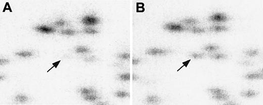 Fig. 2. RLGS profiles demonstrating methylation of fragment 3B36 (arrow) in diagnostic sample compared with remission sample from same patient. / Comparison of RLGS profile of AML diagnostic sample (panel A) and remission sample (panel B), showing absence of fragment 3B36, theCPY1B1 gene, in AML diagnostic sample owing to methylation.