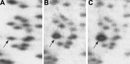 Fig. 3. RLGS mixing gels used in cloning procedure. / Normal PB genomic DNA (panel A) with no additionalNotI-EcoRV clone. PB with 5.2 pg (panel B) and 20.8 pg (panel C) of the radiolabeled candidate clone added to the genomic DNA. Progressive enhancement of the RLGS fragment of interest confirms identification of the correct NotI-EcoRV clone.