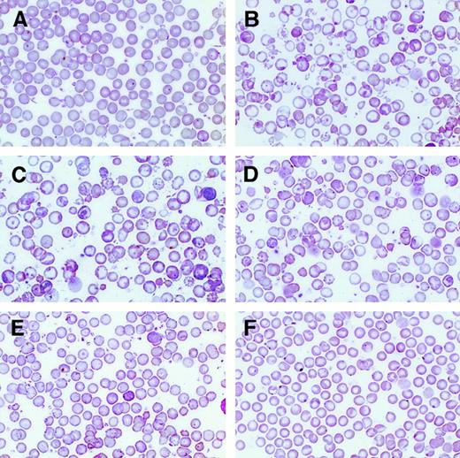Fig. 8. Correction of β-thalassemic red cell morphologic abnormalities as a function of the level of human globin transgene expression. / Wright-Giemsa–stained PB smears from wild-type (panel A) and β-thalassemic (panel B) littermate controls are shown (250 × magnification) along with smears from strain A (panel C), strain B (panel D), strain C (panel E), and strain D (panel F).