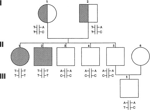 Fig. 1. Pedigree of Norwegian family. / Fully shaded areas show homozygotes for P5′N-1 deficiency, and half-shaded symbols show heterozygotes, based on P5′N-1/P5′N-2 ratios. Letters show the results of genotyping the P5′N-1. Upper letters refer to mutations of codon 98 (A, wild type; T, mutated) and lower letters refer to codon 92 (C, wild type; T, mutated). Reduced P5′N-1 activity segregates with the codon 98 T mutation and with the T/T haplotype.