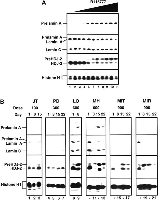 Fig. 2. Effect of R115777 on FT-dependent processing of prelamin A and HDJ-2 in K562 cells in vitro and in leukemic bone marrow samples in situ. / (A) Log-phase K562 cells were incubated for 24 hours with diluent (lane 1) or concentrations of R115777 ranging from 0.78 to 100 nM in 2-fold increments (lanes 2-11). At the completion of the incubation, samples were sedimented at 200g, washed once in serum-free RPMI 1640, and prepared for analysis as described in “Patients, materials, and methods.” R115777 causes a dose-dependent increase in signals for prelamin A and HDJ-2. (B) Bone marrow samples harvested before therapy (day 0) or at weekly intervals during therapy with the indicated dose of R115777 were prepared for immunoblotting as described in “Patients, materials, and methods.” Inhibition of prelamin A and pre–HDJ-2 processing at the 100 and 300 mg bid doses was not detected. Prelamin A appeared in some samples obtained from patients during treatment with 600 and 900 mg (eg, LO and MH, lanes 8-13). In samples from other patients, lamin A was undetectable before treatment (MIT, lanes 14-17) or disappeared during the course of treatment (eg, MIR, lanes 18-21), making it impossible to use prelamin A as a marker of FT inhibition. In contrast, an increase in pre–HDJ-2 was detectable in many of these same samples, as illustrated in lanes 14-21 and summarized in Table 4. The median blast count for the day 1 samples shown in this figure was 90%.