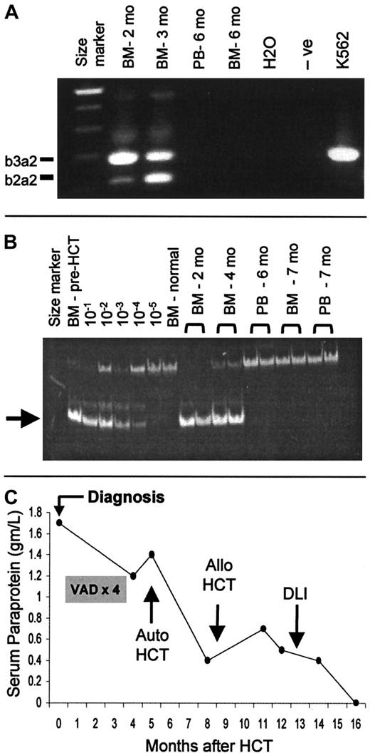 Fig. 5. Complete disease responses after HCT. / (A) Example of molecular remission of CML (patient FH14726) induced by HCT without DLI, as documented by failure of reverse transcription–PCR to detect bcr-abl transcripts. The lane described “−ve” is a negative control of normal bone marrow (BM). K562 is a positive control for bcr-abl. (B) Example of molecular remission of CLL induced by HCT (patient FH12914) without DLI, as documented by PCR to detect a tumor-specific immunoglobulin heavy-chain gene rearrangement (arrow). Each posttransplantation sample was amplified in duplicate. The lanes designated 10−1 to 10−5 show a dilution series of the patient's pretransplantation sample (more than 90% tumor cells) into normal bone marrow. (C) Example of complete remission of MM (patient FH13922) after allogeneic HCT. The patient was initially treated with 4 cycles of vincristine, adriamycin, and dexamethasone (VAD). High-dose cytoreduction with melphalan 200 mg/m2 and autologous transplantation were performed 3 months before allogeneic HCT. DLI was given 4 months after HCT because of persistent tumor. After CR was achieved, trace levels of serum monoclonal paraprotein detected by immunofixation were present intermittently in follow-up testing.