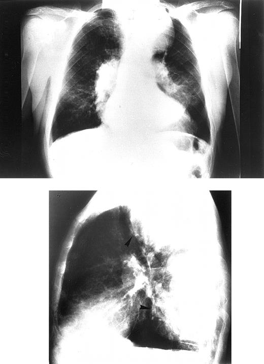 Fig. 1. Chest radiograph of the oldest patient with congestive heart failure. / Frontal view (upper panel). Lateral view (lower panel). Patient shows signs of pulmonary hypertension combined with large intrathoracic extramedullary hemopoietic masses.