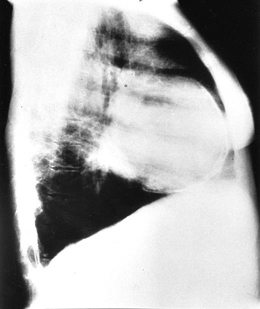 Fig. 2. Chest radiograph of a 42-year-old patient. / Lateral view shows pericardial calcification and enlargement of ribs.
